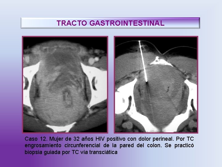 TRACTO GASTROINTESTINAL Caso 12. Mujer de 32 años HIV positivo con dolor perineal. Por