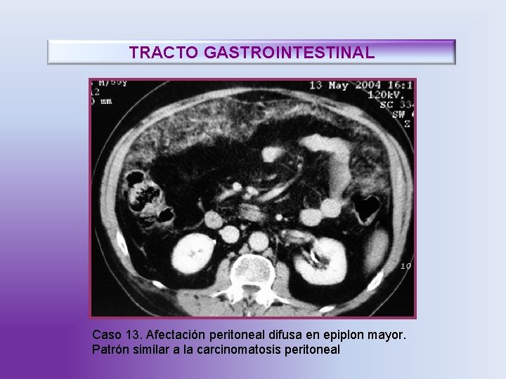 TRACTO GASTROINTESTINAL Caso 13. Afectación peritoneal difusa en epiplon mayor. Patrón similar a la