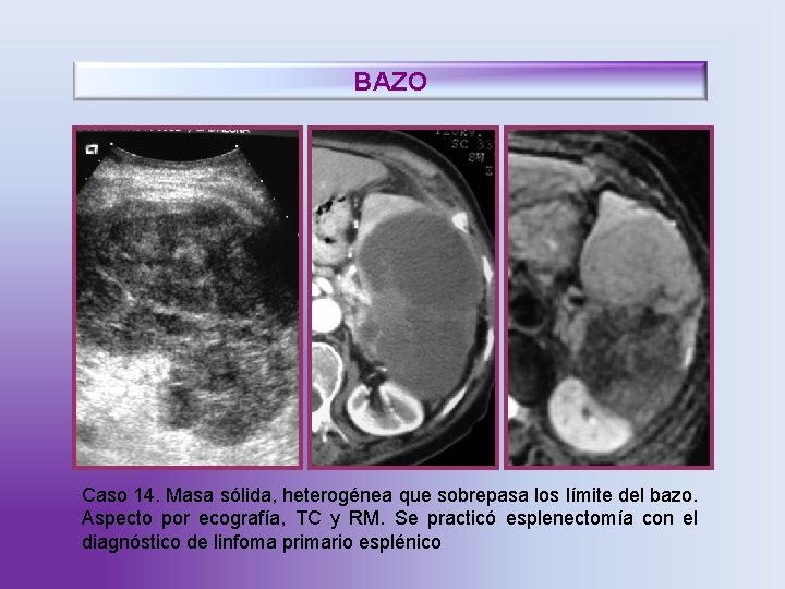 BAZO Caso 14. Masa sólida, heterogénea que sobrepasa los límite del bazo. Aspecto por