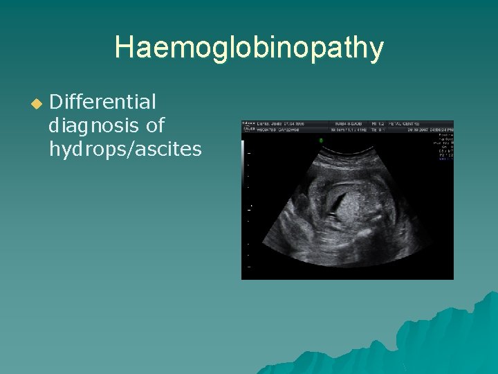 Haemoglobinopathy u Differential diagnosis of hydrops/ascites 
