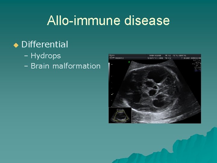 Allo-immune disease u Differential – Hydrops – Brain malformation 