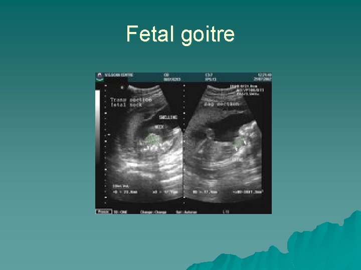 Fetal goitre 