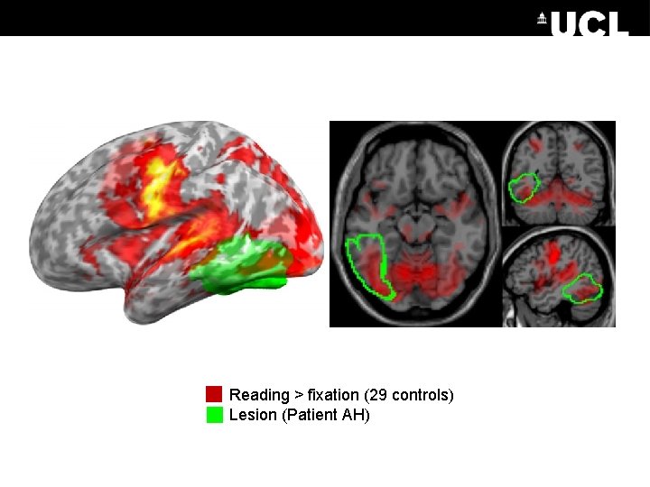 Reading > fixation (29 controls) Lesion (Patient AH) 