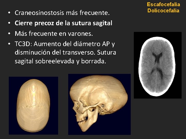 • • Craneosinostosis más frecuente. Cierre precoz de la sutura sagital Más frecuente • • Craneosinostosis más frecuente. Cierre precoz de la sutura sagital Más frecuente