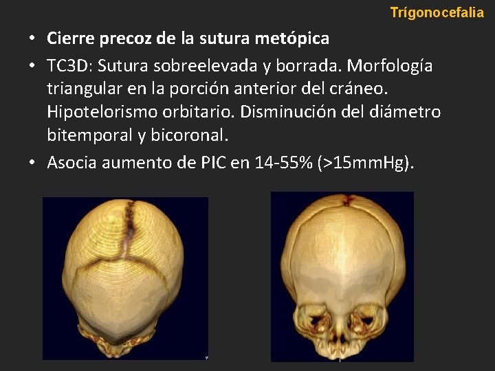 Trígonocefalia • Cierre precoz de la sutura metópica • TC 3 D: Sutura sobreelevada Trígonocefalia • Cierre precoz de la sutura metópica • TC 3 D: Sutura sobreelevada
