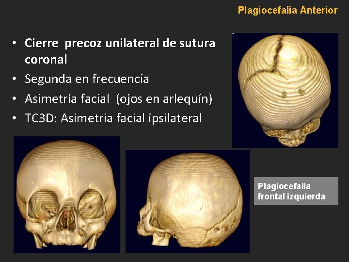 Plagiocefalia Anterior • Cierre precoz unilateral de sutura coronal • Segunda en frecuencia • Plagiocefalia Anterior • Cierre precoz unilateral de sutura coronal • Segunda en frecuencia •