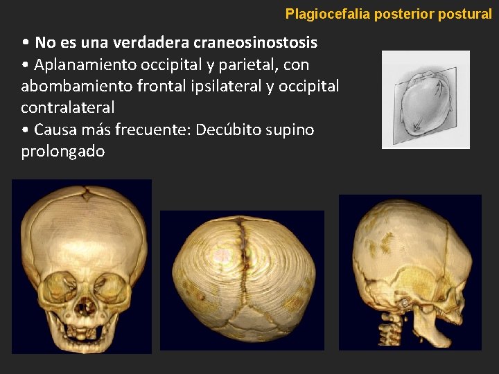 Plagiocefalia posterior postural • No es una verdadera craneosinostosis • Aplanamiento occipital y parietal, Plagiocefalia posterior postural • No es una verdadera craneosinostosis • Aplanamiento occipital y parietal,