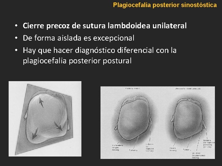 Plagiocefalia posterior sinostóstica • Cierre precoz de sutura lambdoidea unilateral • De forma aislada Plagiocefalia posterior sinostóstica • Cierre precoz de sutura lambdoidea unilateral • De forma aislada
