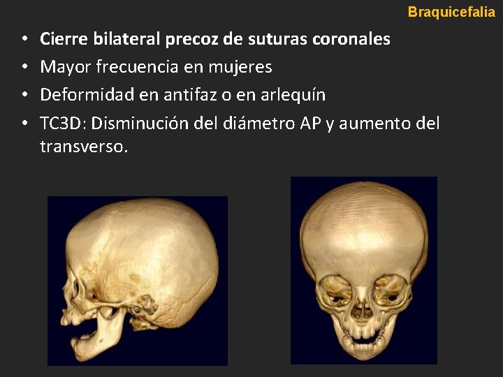 Braquicefalia • • Cierre bilateral precoz de suturas coronales Mayor frecuencia en mujeres Deformidad Braquicefalia • • Cierre bilateral precoz de suturas coronales Mayor frecuencia en mujeres Deformidad