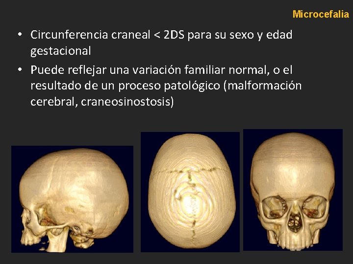 Microcefalia • Circunferencia craneal < 2 DS para su sexo y edad gestacional • Microcefalia • Circunferencia craneal < 2 DS para su sexo y edad gestacional •