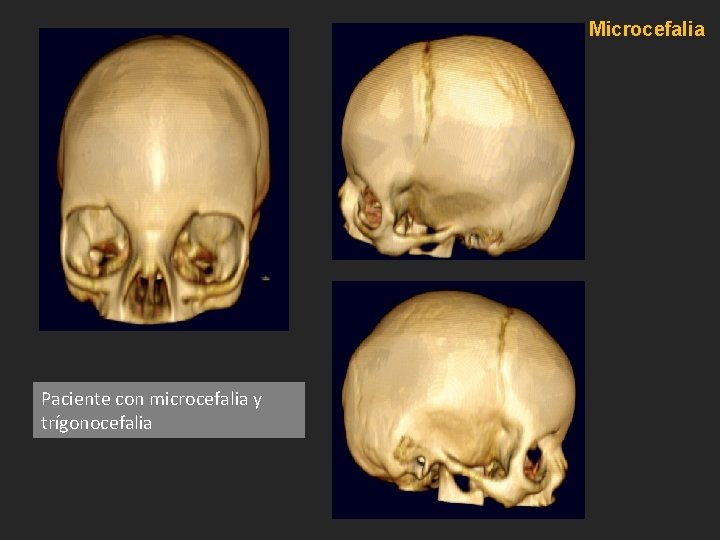 Microcefalia Paciente con microcefalia y trígonocefalia Microcefalia Paciente con microcefalia y trígonocefalia