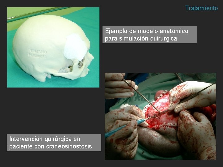 Tratamiento Ejemplo de modelo anatómico para simulación quirúrgica Intervención quirúrgica en paciente con craneosinostosis Tratamiento Ejemplo de modelo anatómico para simulación quirúrgica Intervención quirúrgica en paciente con craneosinostosis