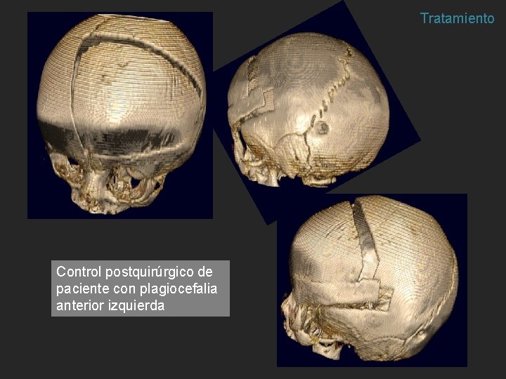 Tratamiento Control postquirúrgico de paciente con plagiocefalia anterior izquierda Tratamiento Control postquirúrgico de paciente con plagiocefalia anterior izquierda
