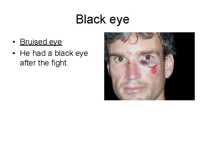 Black eye • Bruised eye • He had a black eye after the fight.