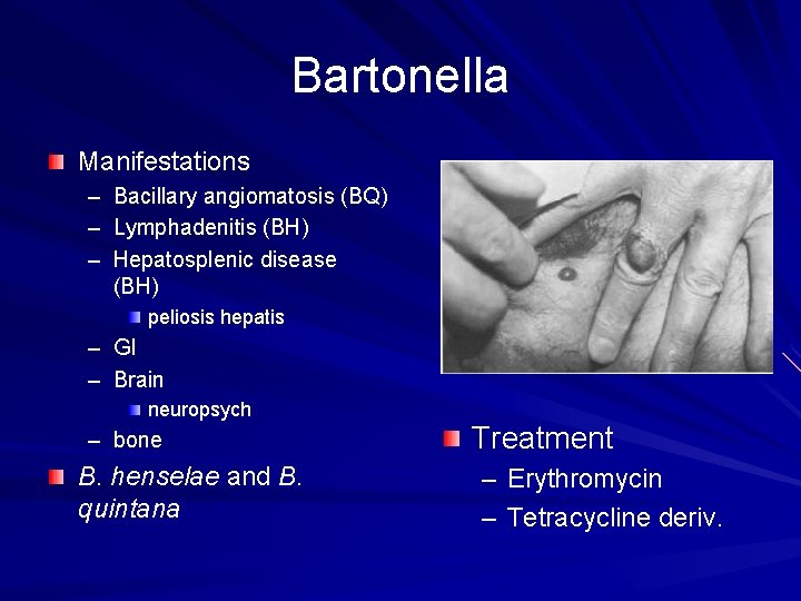 Bartonella Manifestations – – – Bacillary angiomatosis (BQ) Lymphadenitis (BH) Hepatosplenic disease (BH) peliosis