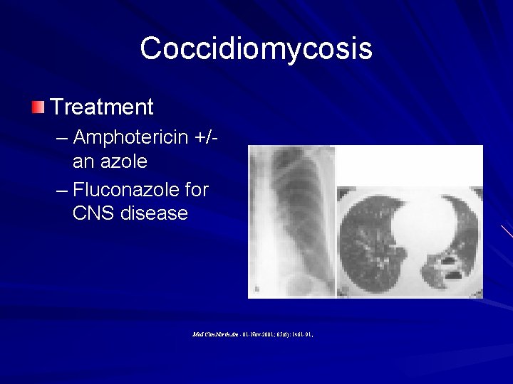 Coccidiomycosis Treatment – Amphotericin +/- an azole – Fluconazole for CNS disease Med Clin