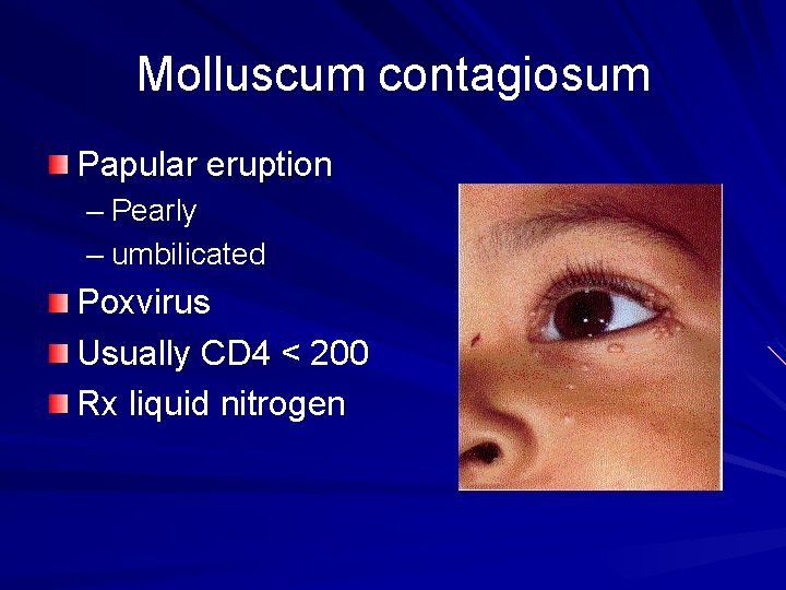 Molluscum contagiosum Papular eruption – Pearly – umbilicated Poxvirus Usually CD 4 < 200
