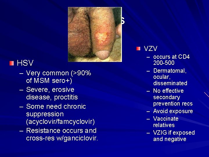 Herpes VZV HSV – Very common (>90% of MSM sero+) – Severe, erosive disease,