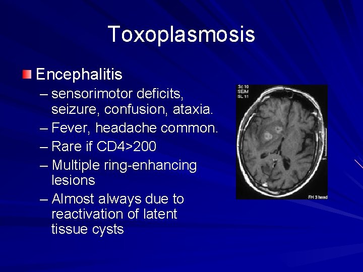 Toxoplasmosis Encephalitis – sensorimotor deficits, seizure, confusion, ataxia. – Fever, headache common. – Rare