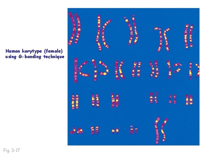 Human karytype (female) using G-banding technique Fig. 3 -17 