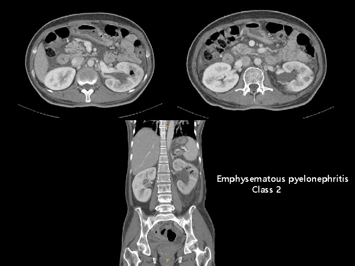 Emphysematous pyelonephritis Class 2 