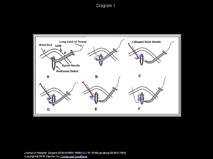 Diagram 1 Journal of Pediatric Surgery 2019 541505 -1509 DOI: (10. 1016/j. jpedsurg. 2019.