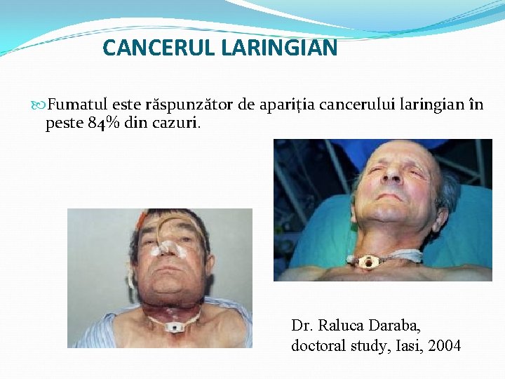 CANCERUL LARINGIAN Fumatul este răspunzător de apariția cancerului laringian în peste 84% din cazuri.