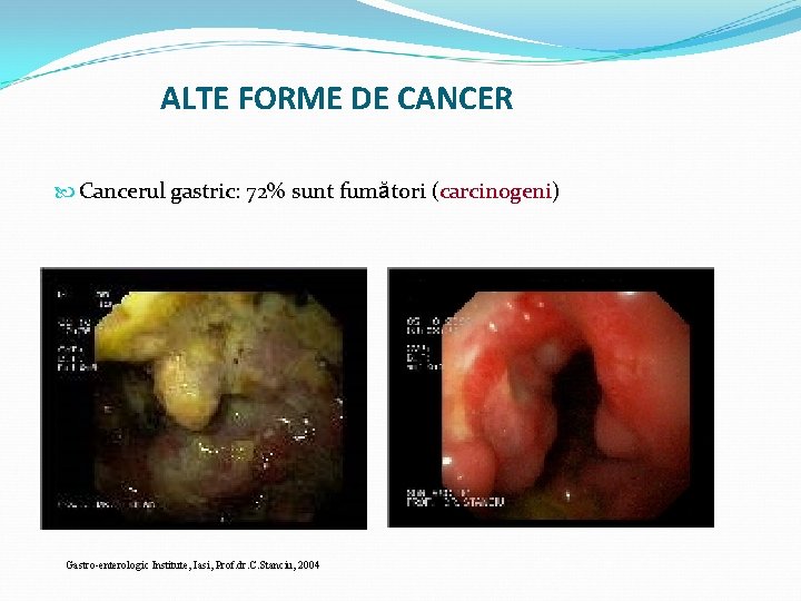 ALTE FORME DE CANCER Cancerul gastric: 72% sunt fumători (carcinogeni) Gastro-enterologic Institute, Iasi, Prof.
