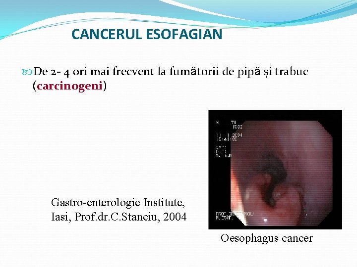 CANCERUL ESOFAGIAN De 2 - 4 ori mai frecvent la fumătorii de pipă și