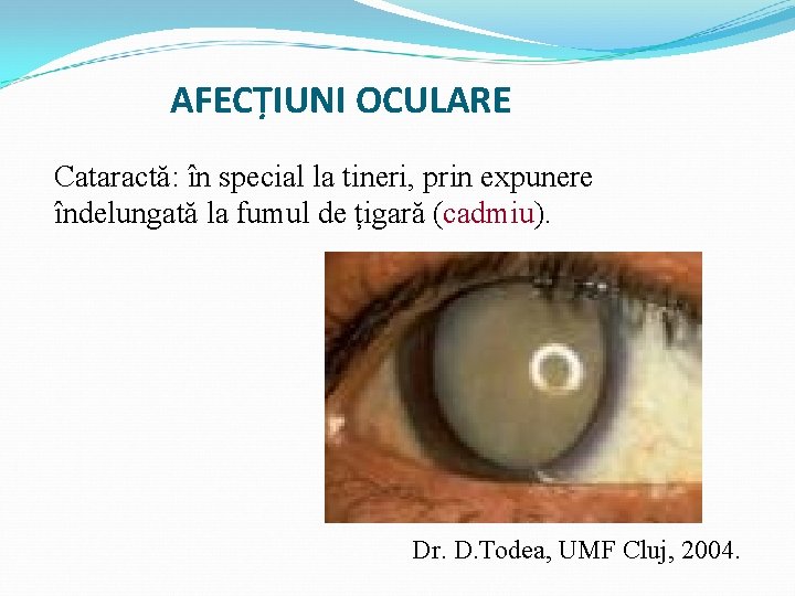 AFECȚIUNI OCULARE Cataractă: în special la tineri, prin expunere îndelungată la fumul de țigară