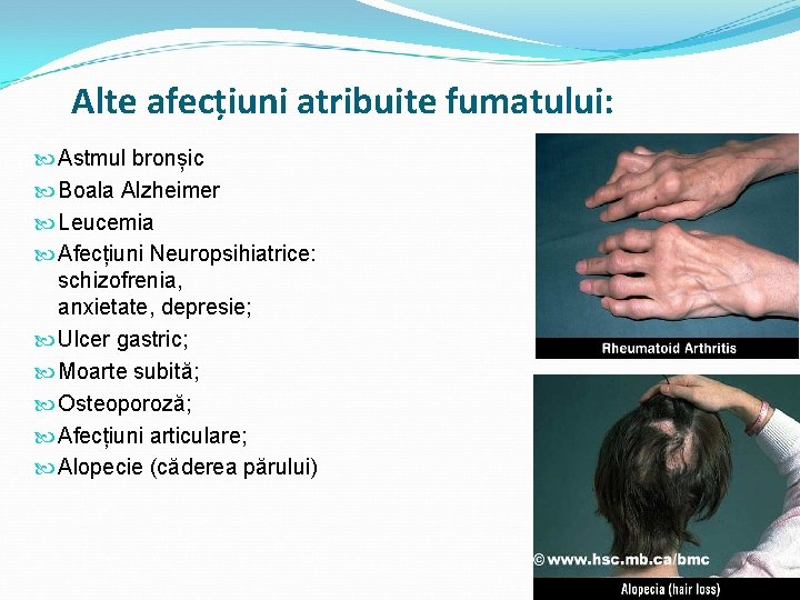 Alte afecțiuni atribuite fumatului: Astmul bronșic Boala Alzheimer Leucemia Afecțiuni Neuropsihiatrice: schizofrenia, anxietate, depresie;