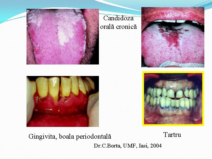 Candidoza orală cronică Gingivita, boala periodontală Dr. C. Borta, UMF, Iasi, 2004 Tartru 