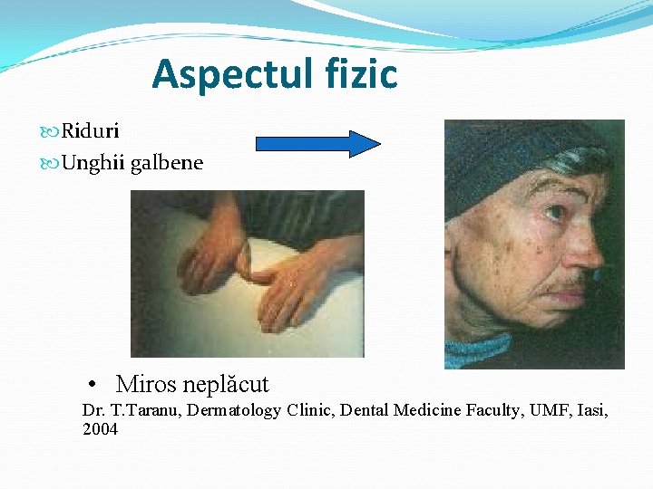 Aspectul fizic Riduri Unghii galbene • Miros neplăcut Dr. T. Taranu, Dermatology Clinic, Dental