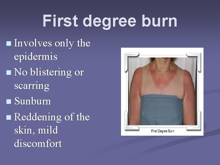 First degree burn n Involves only the epidermis n No blistering or scarring n