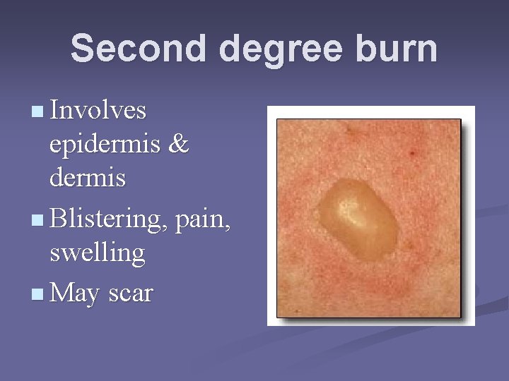 Second degree burn n Involves epidermis & dermis n Blistering, pain, swelling n May