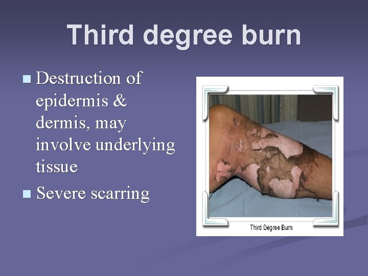 Third degree burn n Destruction of epidermis & dermis, may involve underlying tissue n