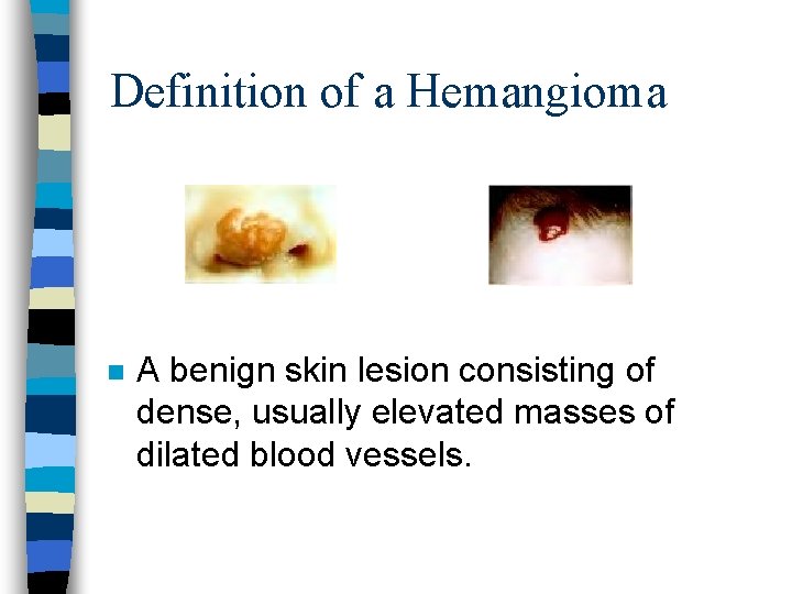 Definition of a Hemangioma n A benign skin lesion consisting of dense, usually elevated