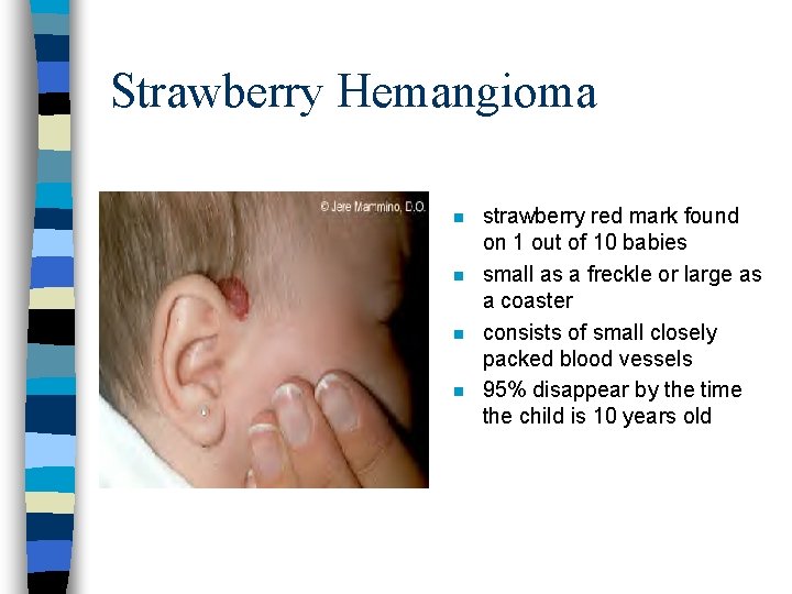 Strawberry Hemangioma n n strawberry red mark found on 1 out of 10 babies