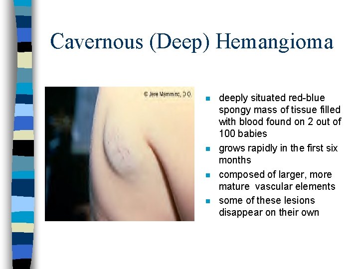 Cavernous (Deep) Hemangioma n n deeply situated red-blue spongy mass of tissue filled with