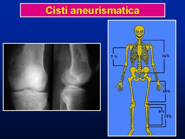 CISTI ANEURISMATICA Cisti aneurismatica Distrofia ossea pseudotumorale