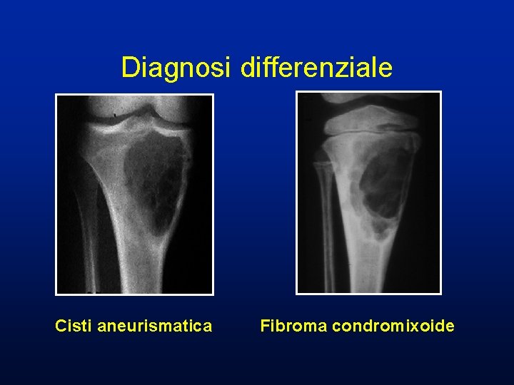 CISTI ANEURISMATICA Cisti aneurismatica Distrofia ossea pseudotumorale