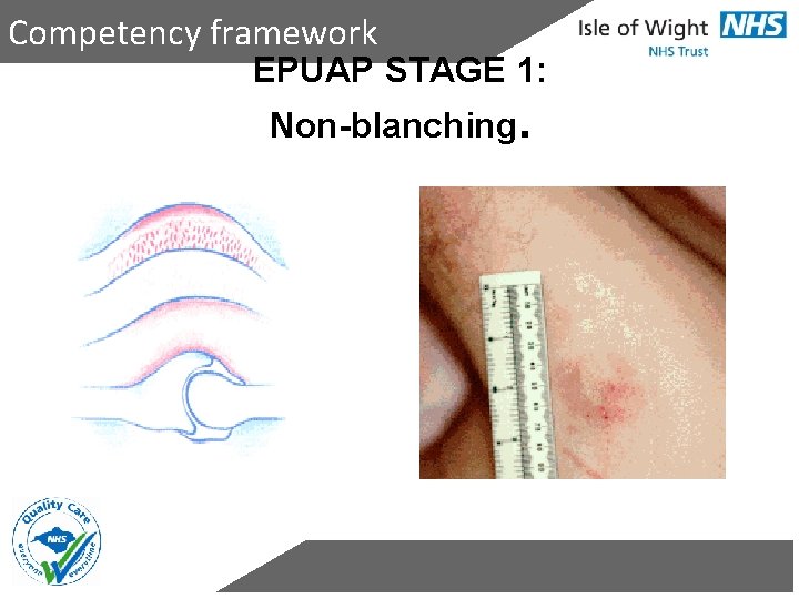 Competency framework EPUAP STAGE 1: Non-blanching. 