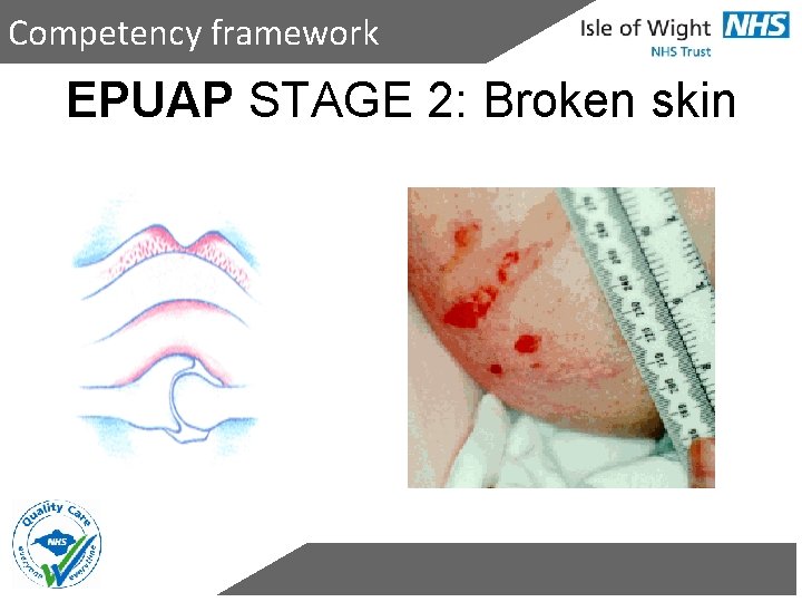 Competency framework EPUAP STAGE 2: Broken skin 