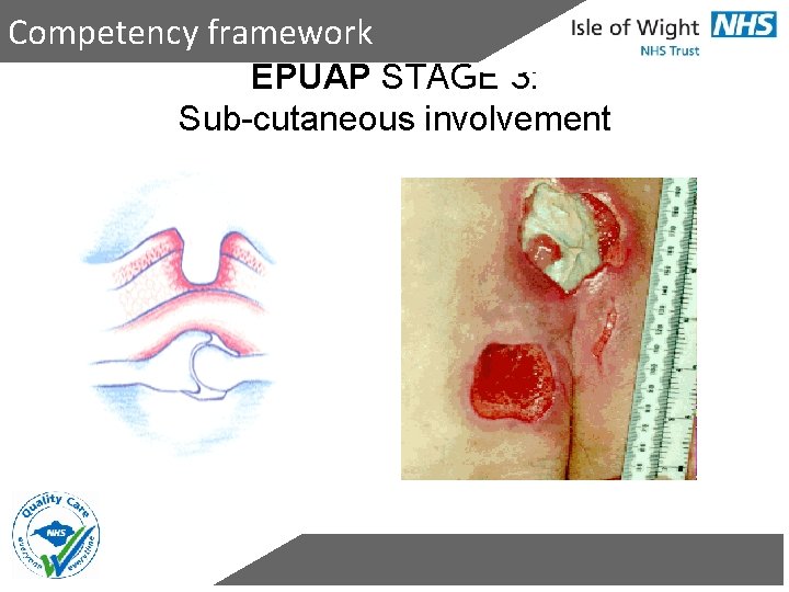 Competency framework EPUAP STAGE 3: Sub-cutaneous involvement 