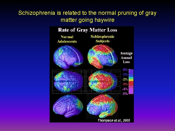 Schizophrenia is related to the normal pruning of gray matter going haywire 