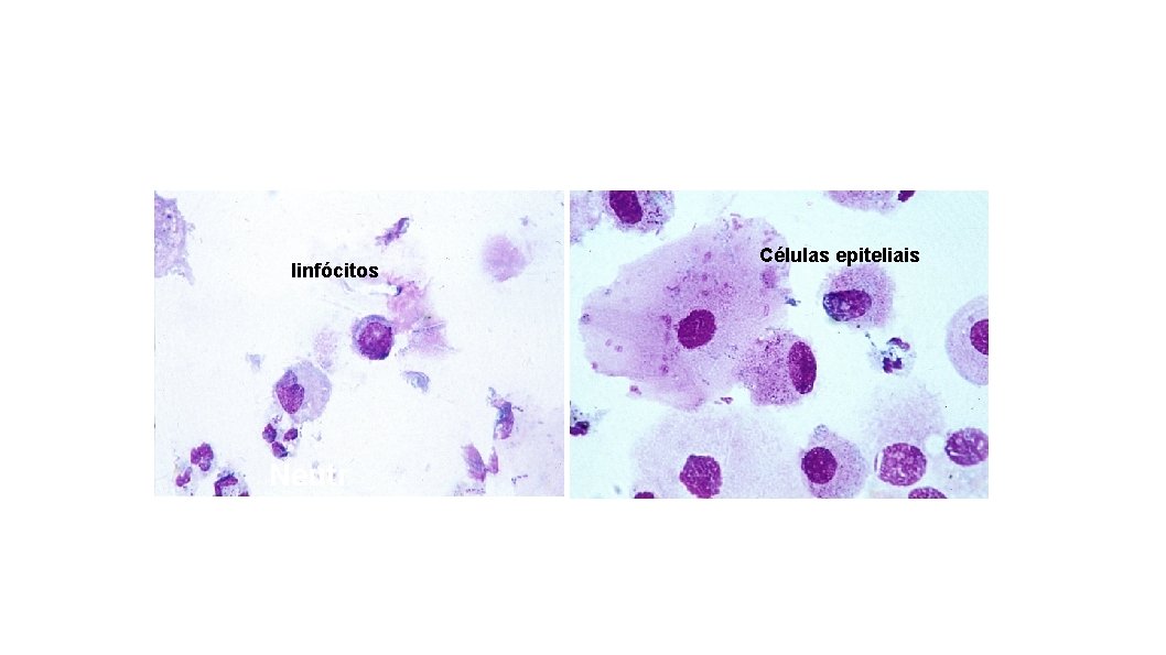 linfócitos Neutr Células epiteliais 