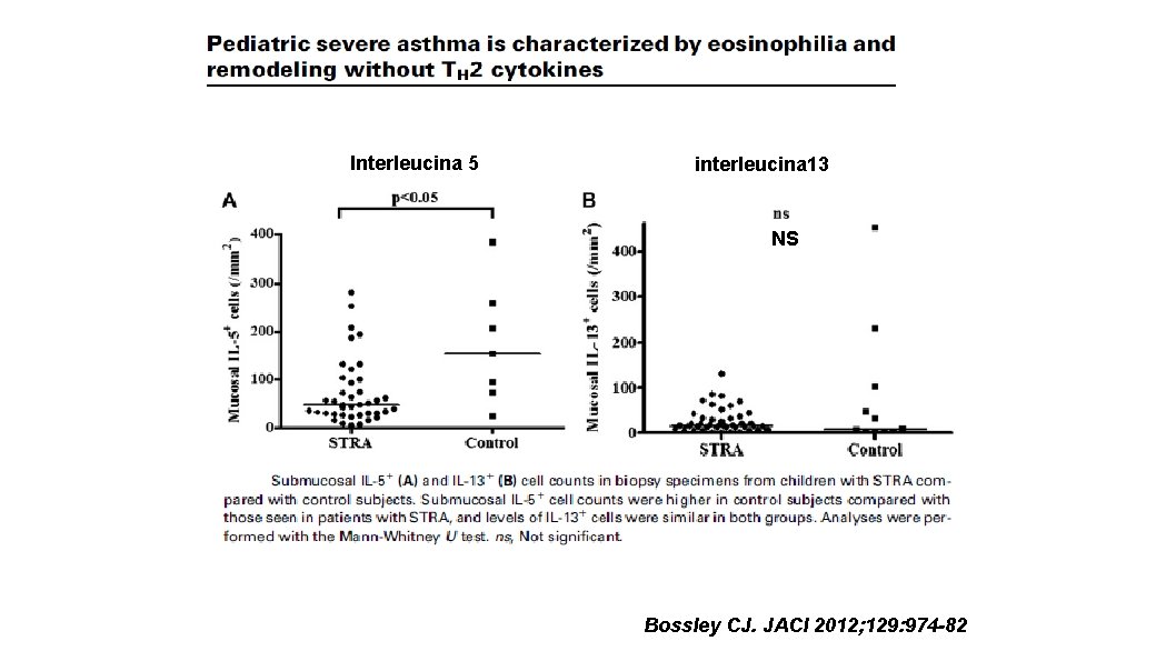 Interleucina 5 interleucina 13 NS Bossley CJ. JACI 2012; 129: 974 -82 
