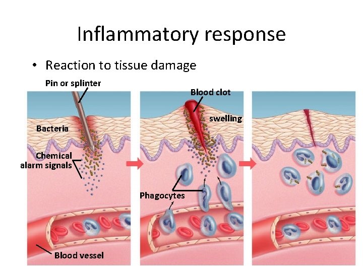 Inflammatory response • Reaction to tissue damage Pin or splinter Blood clot swelling Bacteria