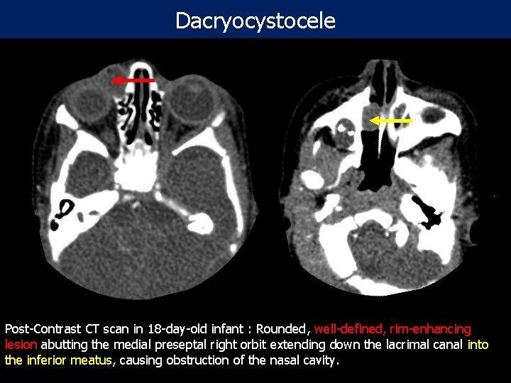 Dacryocystocele Post-Contrast CT scan in 18 -day-old infant : Rounded, well-defined, rim-enhancing lesion abutting