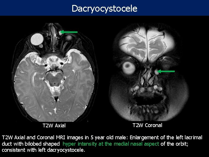 Dacryocystocele T 2 W Axial T 2 W Coronal T 2 W Axial and